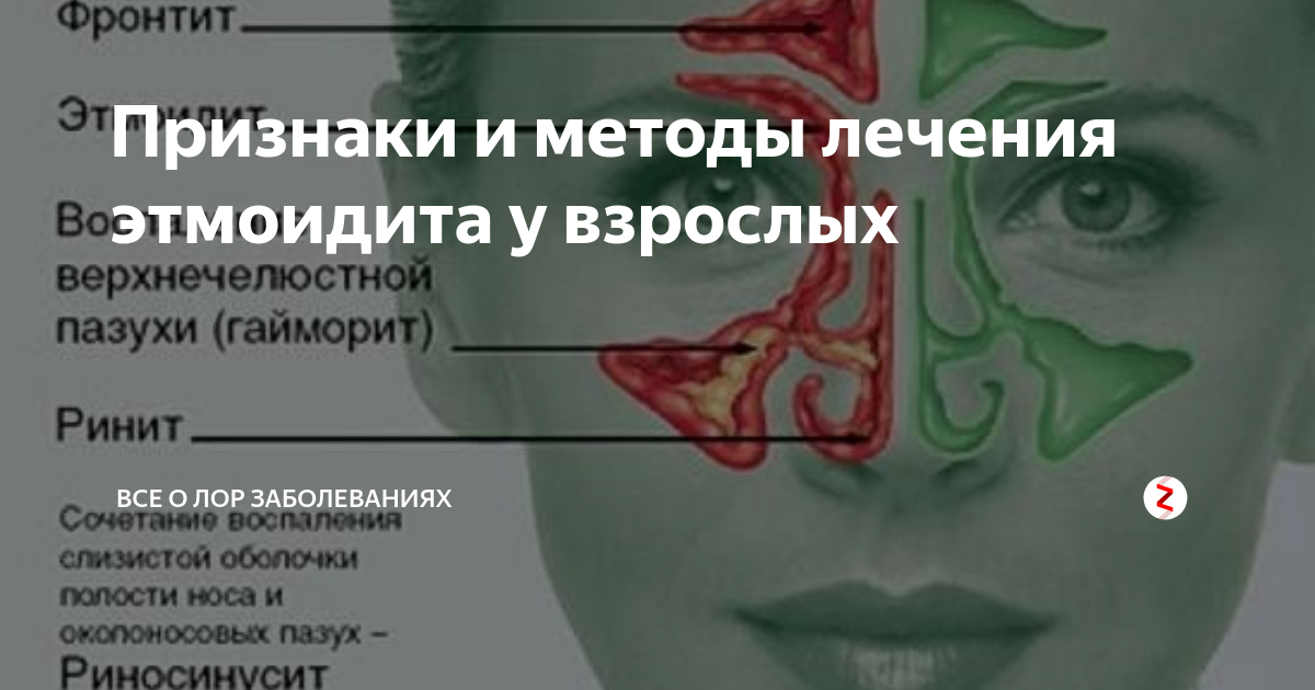 Фронтит схема лечения у взрослых