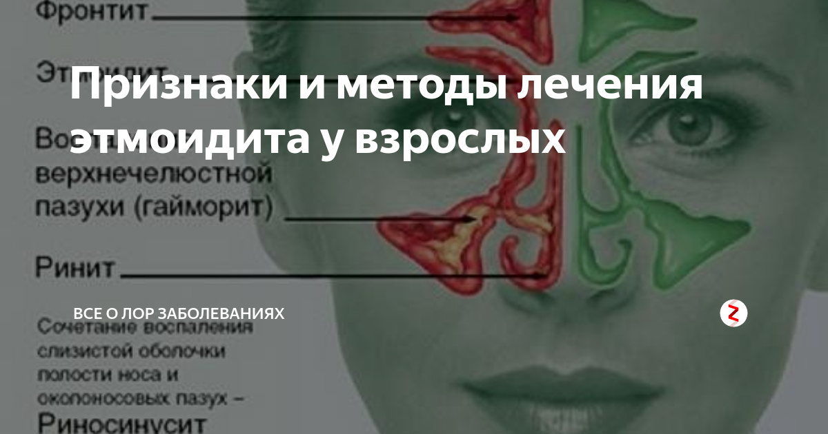 Фронтит от какого слова. Симптомы острого этмоидита. Этмоидит симптоматика. Симптомы хронического этмоидита.