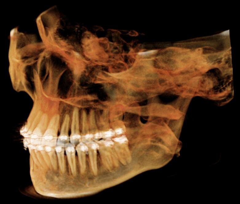 Трехмерный снимок челюсти.