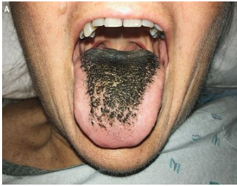 По данным New England Journal of Medicine, у женщины развилось состояние, называемое «черный волосатый язык», после приема антибиотиков для лечения инфекции.  Временное состояние вызвано отсутствием стимуляции верхушки языка, что приводит к накоплению кератина.  