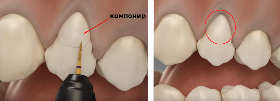 Пластика десны