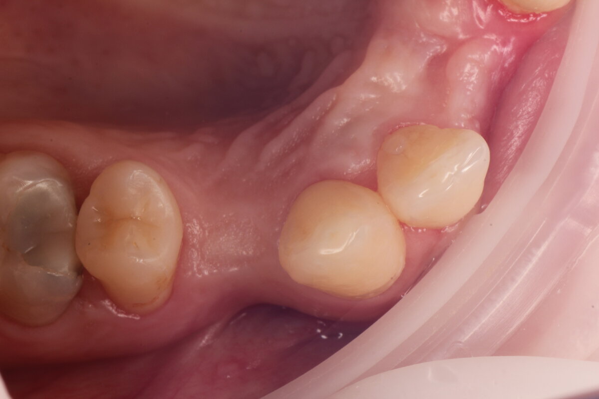До имплантации и наращивания  слизистой
