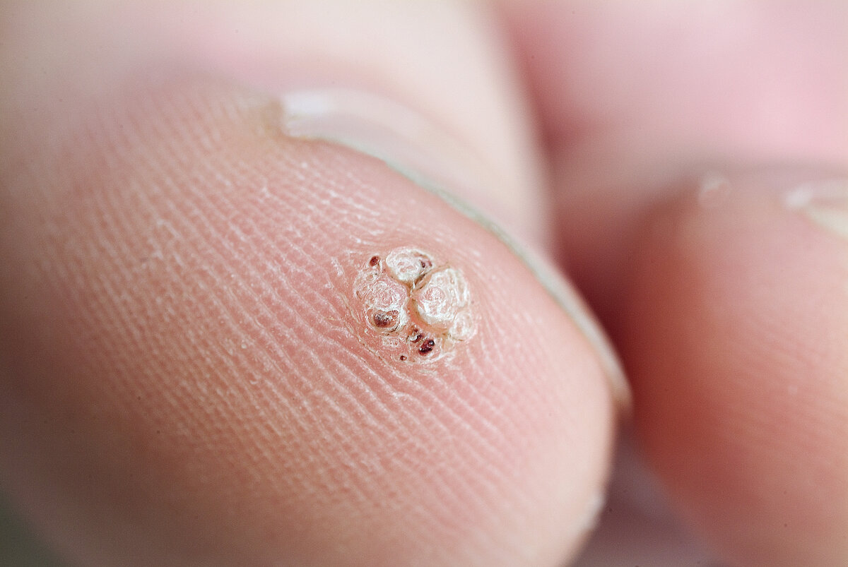 Бородавка на пальце