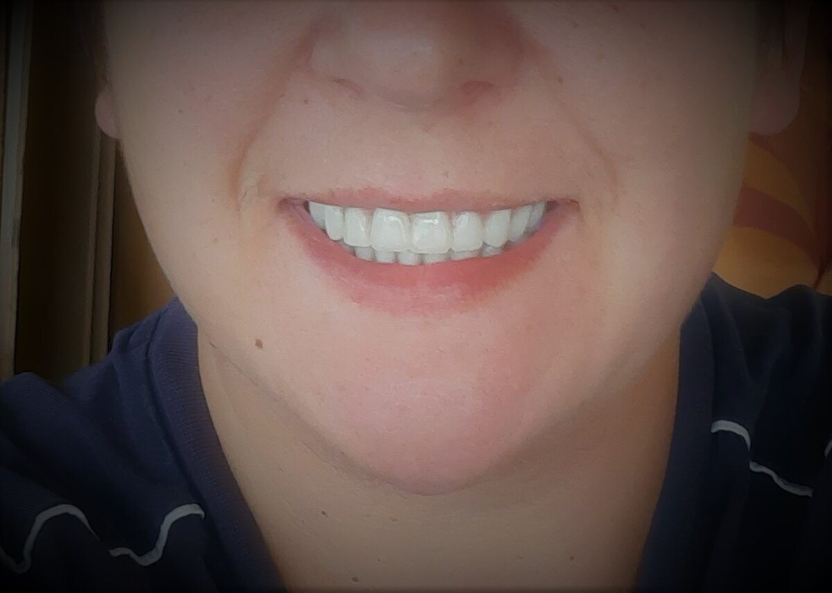 Что стало с золотым сечением через 37 дней после установки адаптационного протеза. 