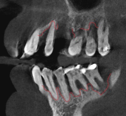 Хронический пародонтит.
