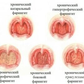 Лечение фарингита в Минске в центре АстартаПлюс