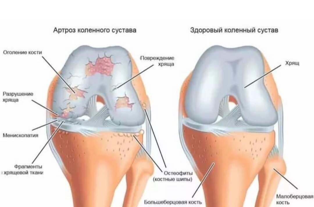 При ОА характерно увеличение, деформация и подвывихи пораженных суставов.