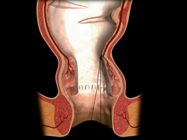 Дезартеризация геморроидальных узлов HAL-RAR
