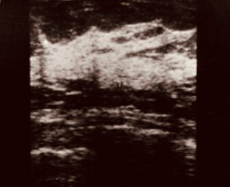 Признаки ФАМ на УЗИ молочных желёз 