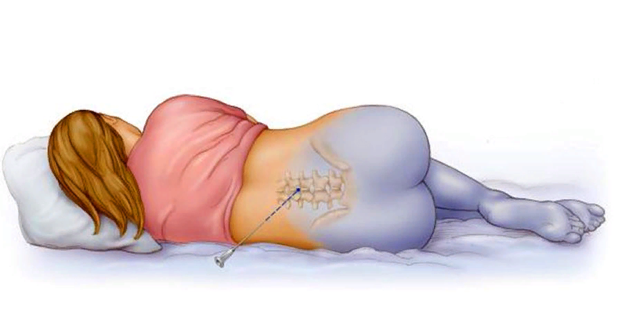 Боли в спине после эпидуральной