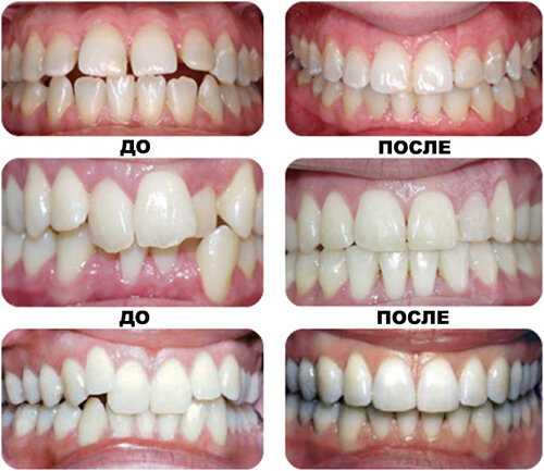 Как выровнять зубы без брекетов? Или о чем не знала Катя Пушкарева