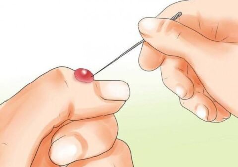  «Вскрывать или нет волдырь после ожоговой травмы?» - вопрос, что волнует многих.