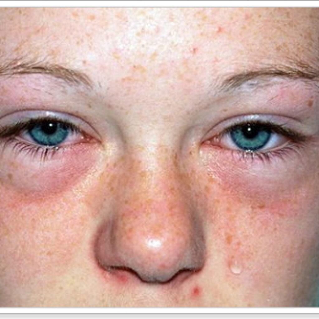 Лечение аллергии на пыльцу