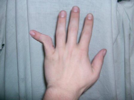  Неестественное положение пальца