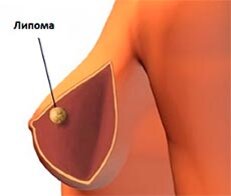 Лечение рака молочной железы народными средствами