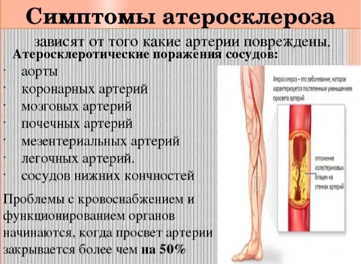 Лечение атеросклероза аорты и болезни периферических артерий в Одессе