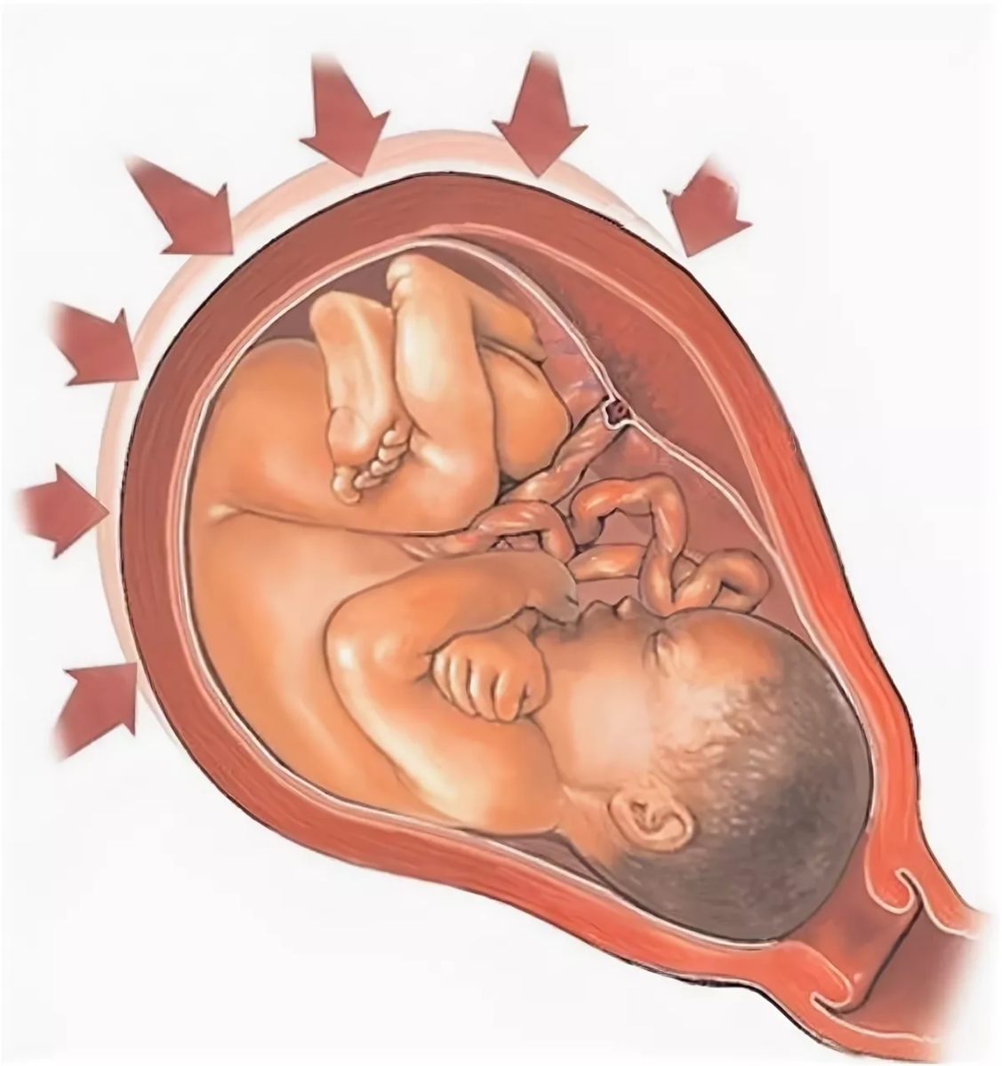 Тонус матки схватки. При тонусе матки при беременности. Тонус матки приибеременрости. Гипертонус матки при беременности.