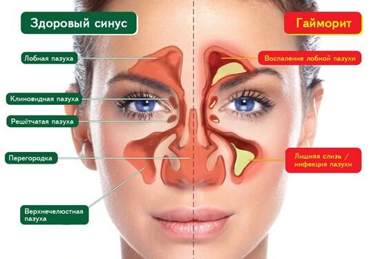 Как вылечить гайморит за 3 дня?