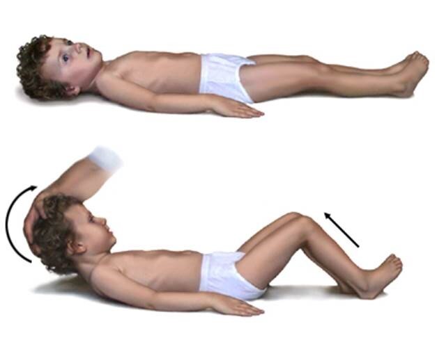 Регидность затылочных мышц