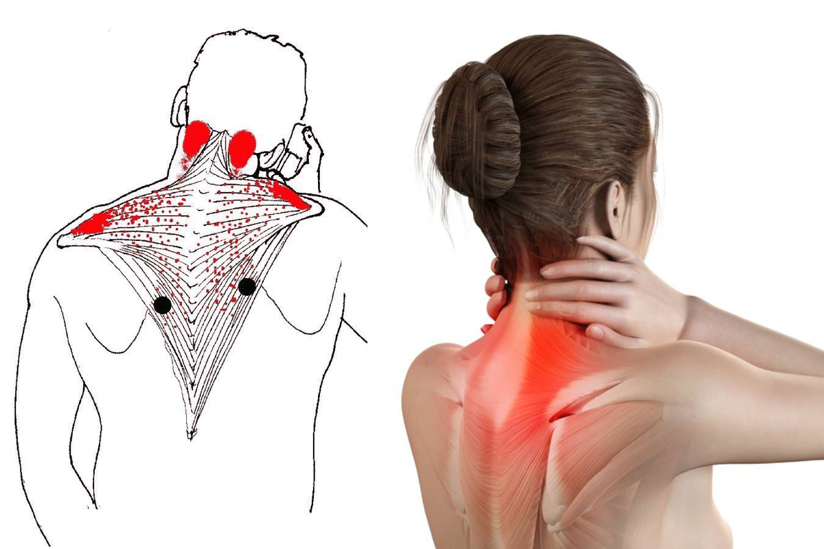 Боль в шее. Болят мышцы шеи. Ременная мышца головы триггерные точки.