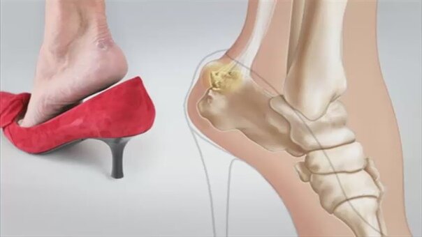 Разрыв связок коленного сустава: лечение без операции