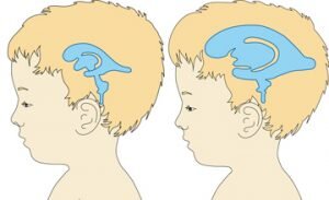 Внутричерепное давление у ребенка - симптомы повышения, признаки, лечение