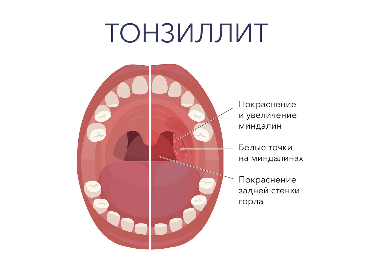 Тонзиллит