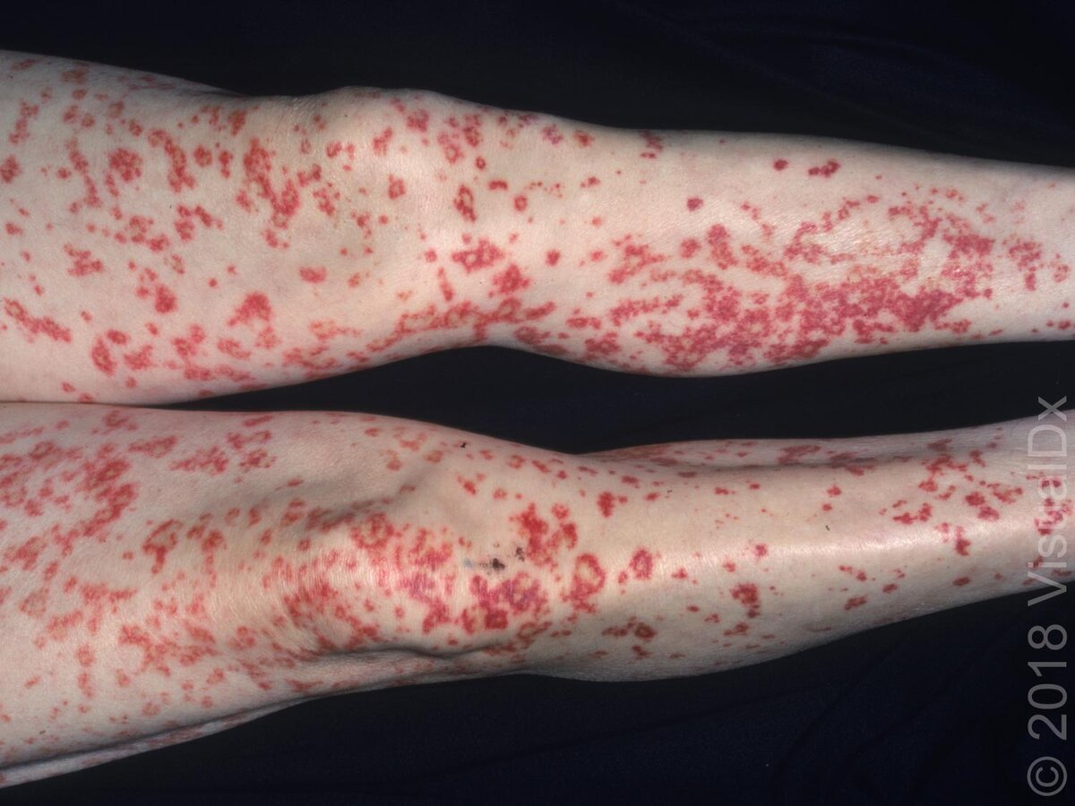 Разбираемся с васкулитом на ногах: от геморрагической сыпи до методов лечения
