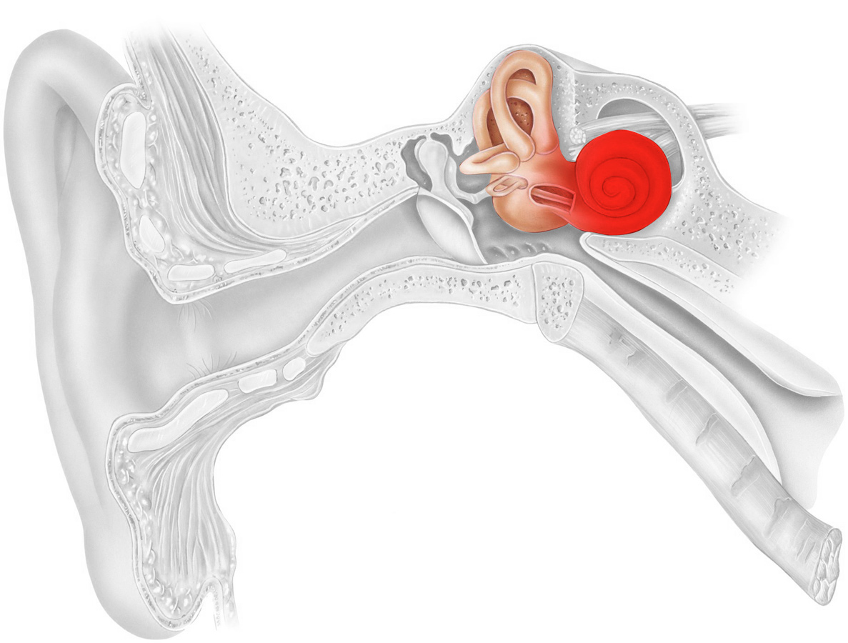 Нарушение среднего уха. Менингогенный лабиринтит. Воспаление среднего уха (лабиринтит);. Тимпаногенный лабиринтит. Травматический лабиринтит.