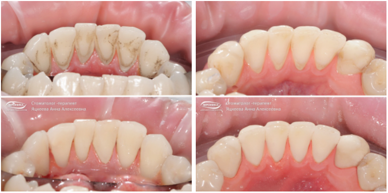 Наглядный пример того, как эффективно она устраняет пигментированный и твердый налет. Работы выполнены стоматологом-терапевтом Яцкеевой Анной Алексеевной.