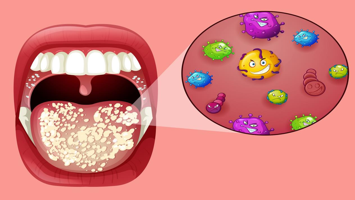 Как избавиться от молочницы во рту и не заболеть ею снова? | Стоматология  ROOTT | Дзен