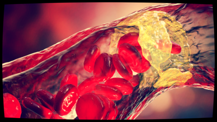 Нет, мы уже не избавимся от бляшки, если она появилась. Но можем изменить ее характер.