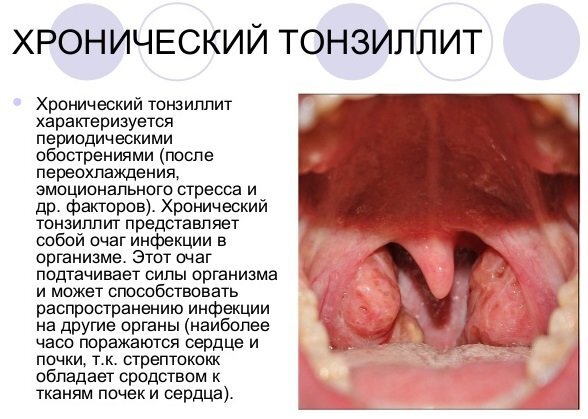 Красное горло у ребенка? Надо лечить?