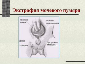 Что такое экстрофия мочевого пузыря у детей - простыми словами