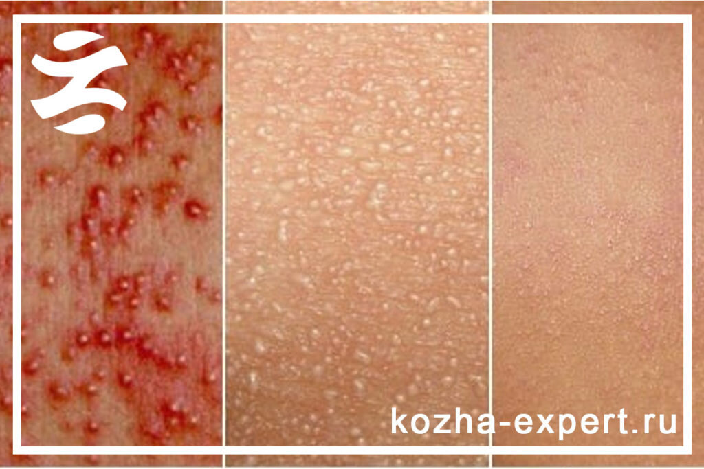 водянистая сыпь