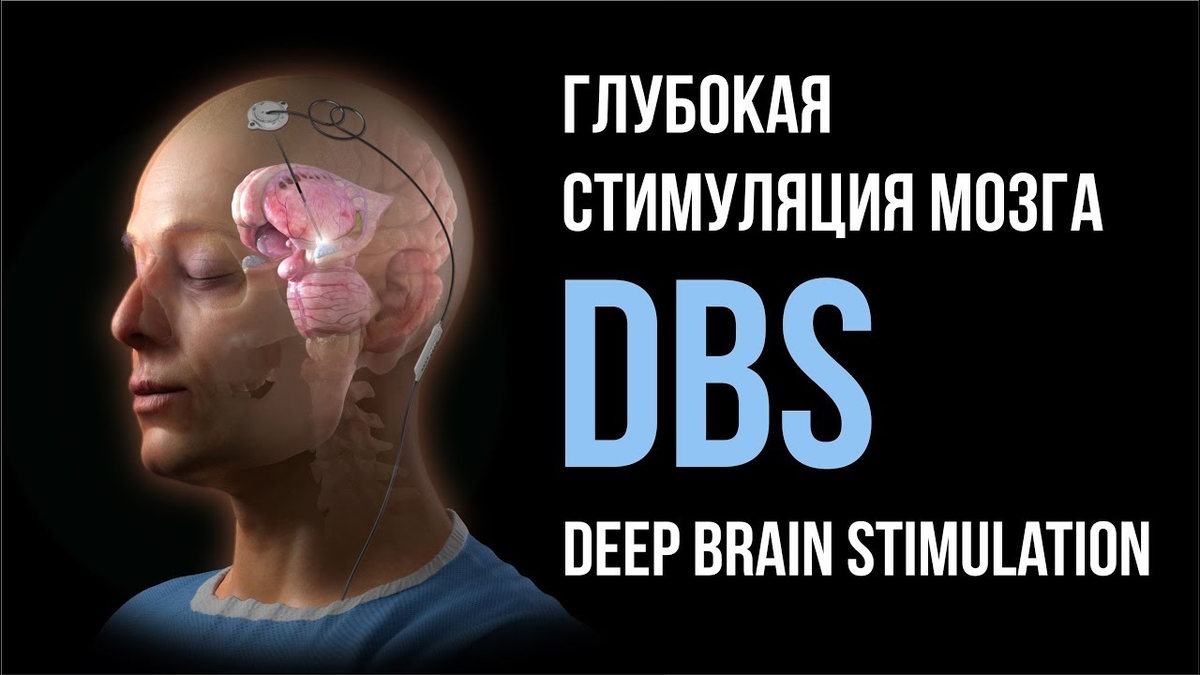 Лечение головного мозга форум. Глубокая стимуляция мозга при болезни Паркинсона. Операция DBS при болезни Паркинсона. Глубокая стимуляция мозга DBS. Deep Brain stimulation глубинная стимуляция мозга.