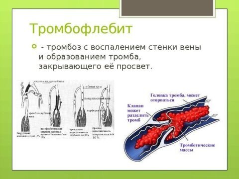  Появление тромбофлебита глубоких вен