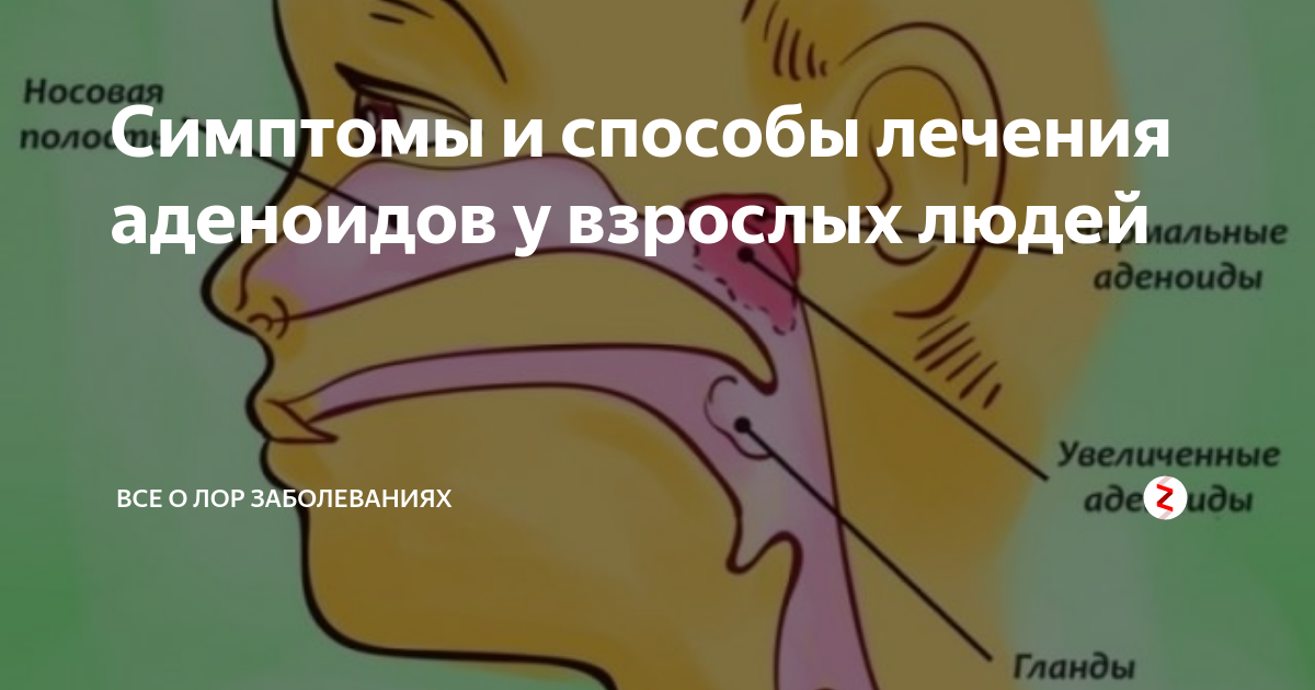 Аденоиды 3 степени фото. Глоточная миндалина аденоиды. Глоточная и трубные миндалины. Глоточная миндалина анатомия. Аденоид у взрослого человека.