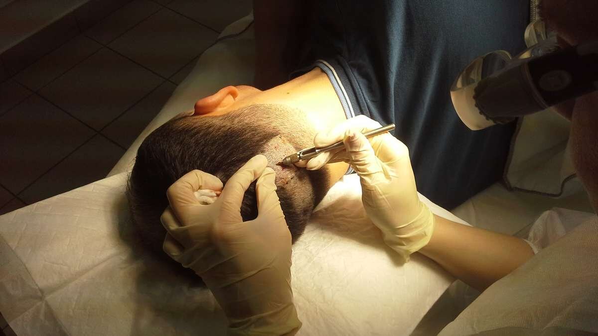 Пересадка волос