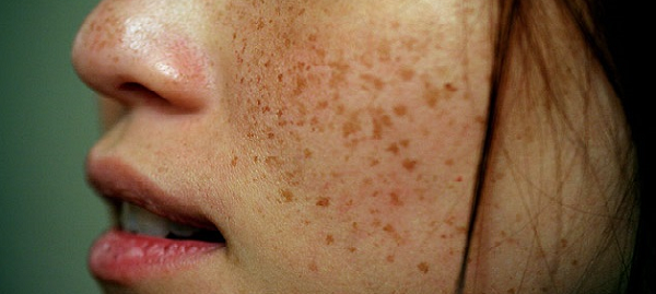 фото: http://bolezni-kozhi.ru