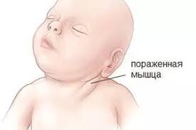 Наиболее эффективно кривошея лечится в возрасте до года, когда мышцы и кости малыша еще окончательно не сформировались и легко поддаются деформации.
