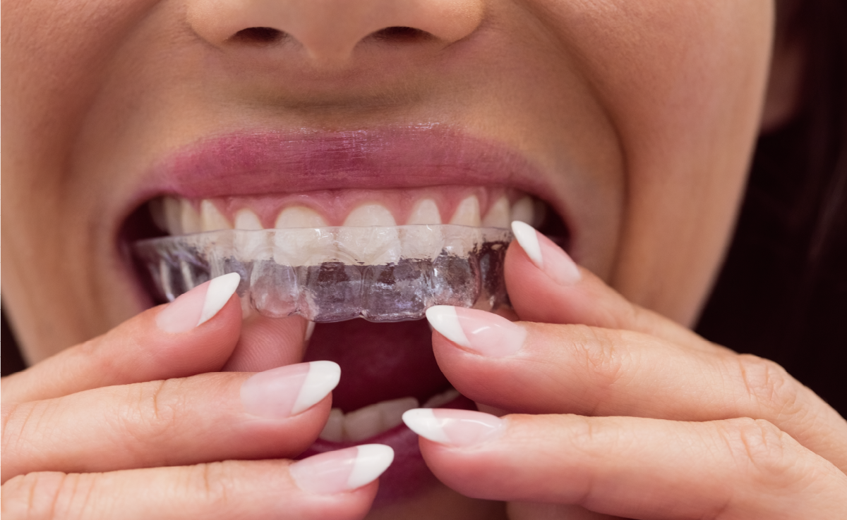 Элайнеры силиконовая капа. Элайнеры как работают. Ортодонтическая капа элайнеры. Каппы инвизилайн invisalign. Ортодонтические каппы (элайнеры).