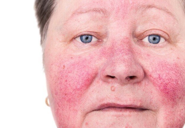 Как убрать красноту кожи лица в домашних условиях