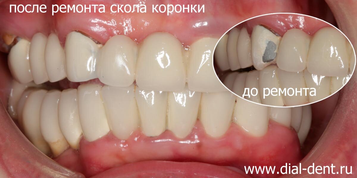 ремонт скола металлокерамики от специалистов "Диал-Дент"