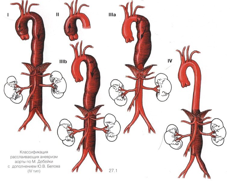 Картинки аневризмы аорты