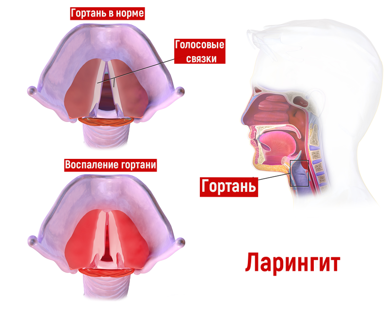 Ларингит: симптомы, диагностика и лечение