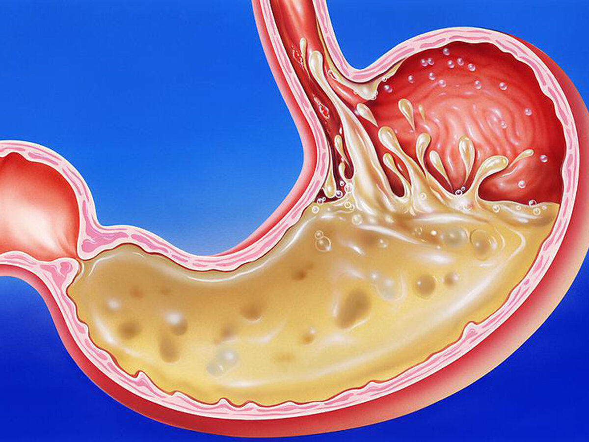 Как восстановить кислотность желудка | ПульсПлюс | Дзен