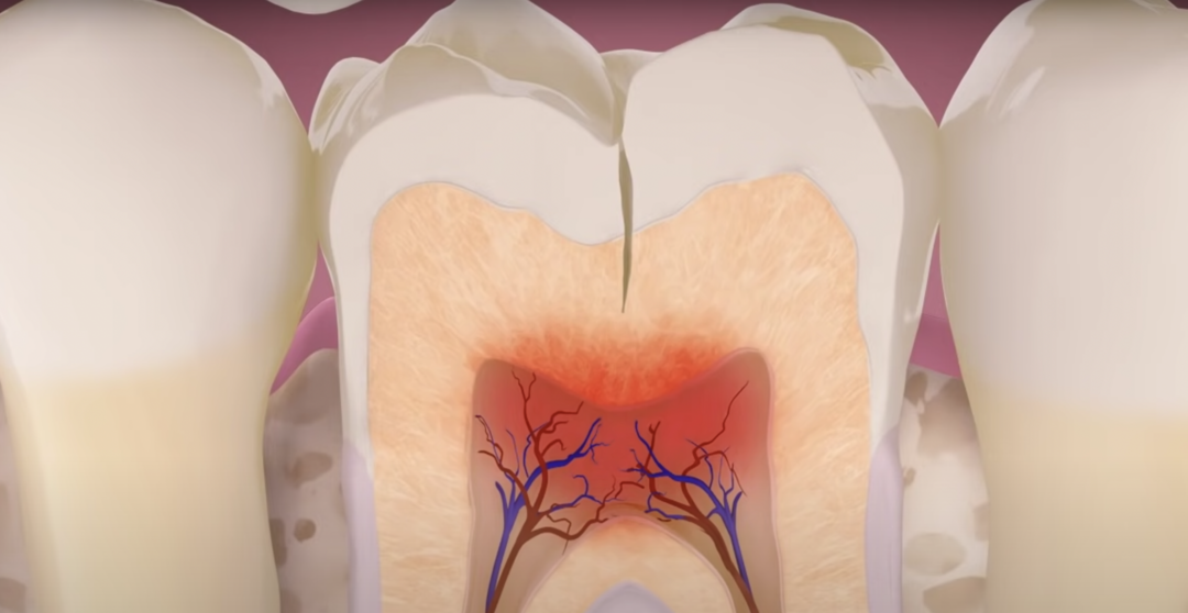 Треснул зуб – причины, первая помощь и лечение