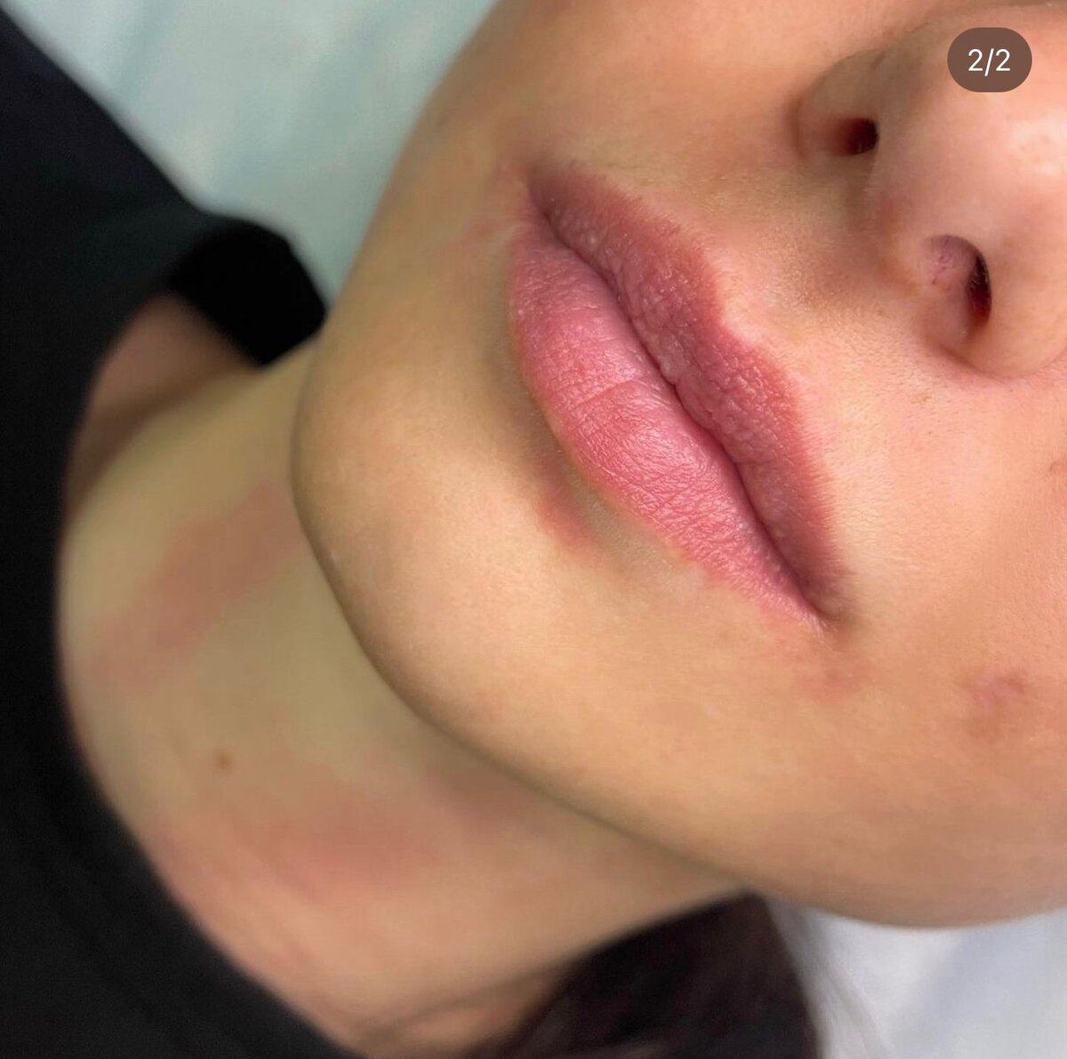 Фото до процедуры.