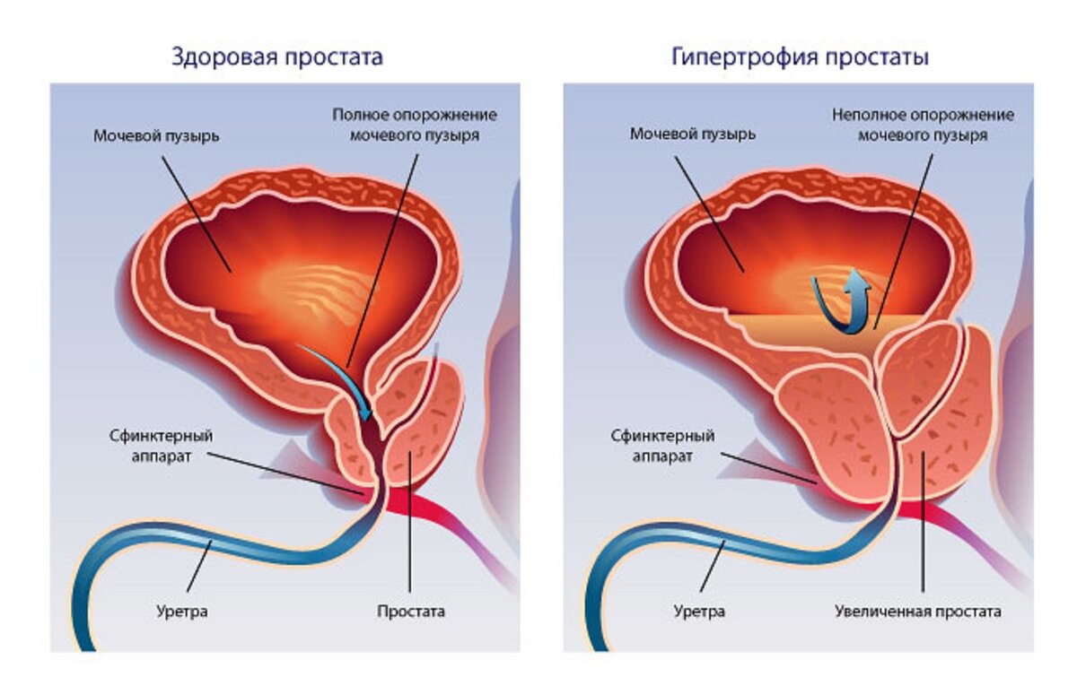 Размер простаты